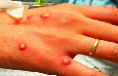 Spain has most Monkeypox cases in the world and two are in the Canary Islands