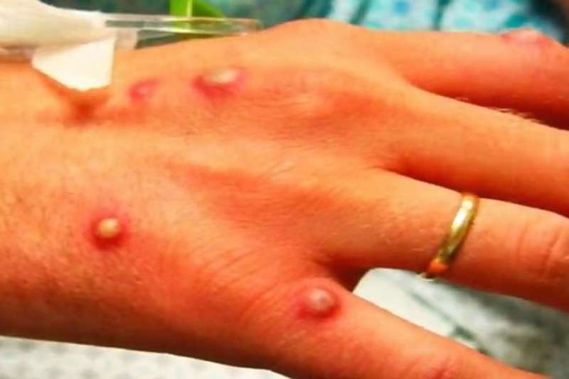 Spain has most Monkeypox cases in the world and two are in the Canary Islands