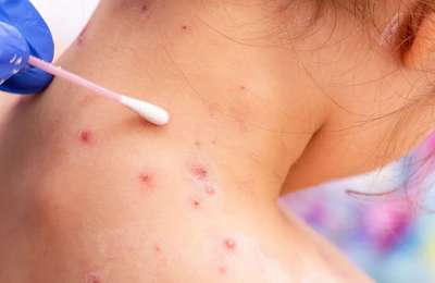 First Monkeypox case is confirmed in the Canary Islands
