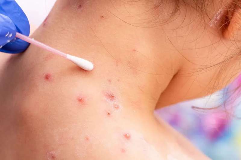 First Monkeypox case is confirmed in the Canary Islands
