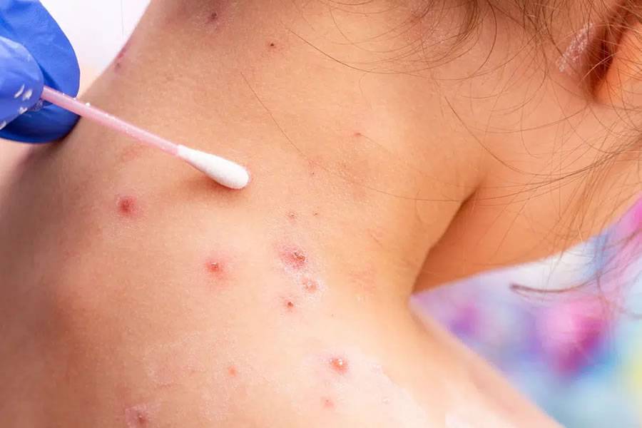 First Monkeypox case is confirmed in the Canary Islands