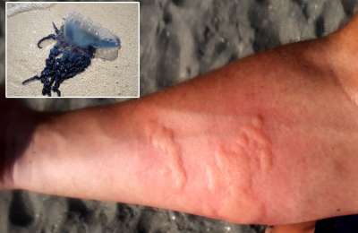Jellyfish injuries tripled over Easter 