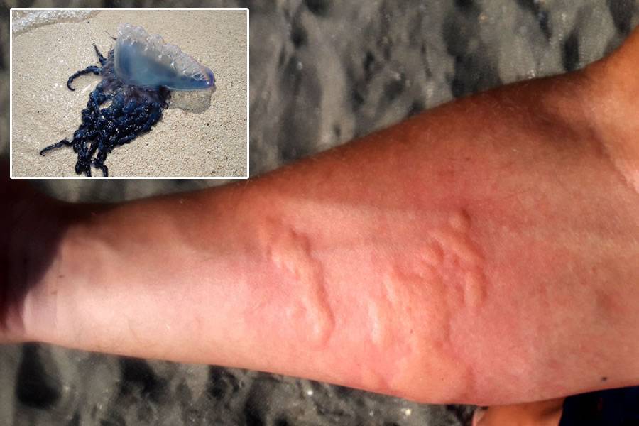 Jellyfish injuries tripled over Easter 