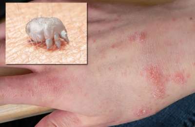 HEALTH WARNING: Eight Scabies outbreaks detected in the Canary Islands 