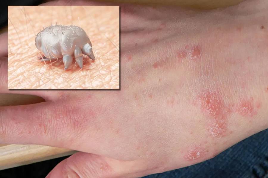 HEALTH WARNING: Eight Scabies outbreaks detected in the Canary Islands 