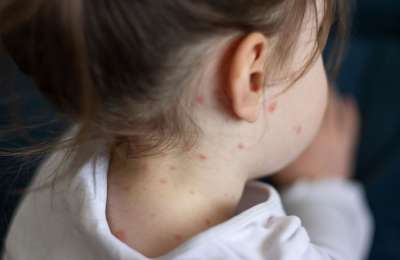 Ministry of Health confirms measles outbreak in Tenerife