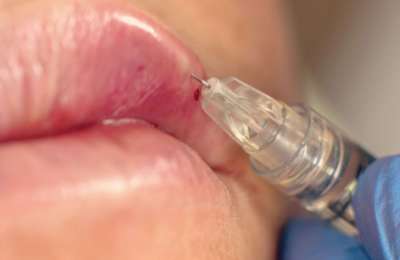 Fake doctor faces 30 years in prison for injecting silicone into clients