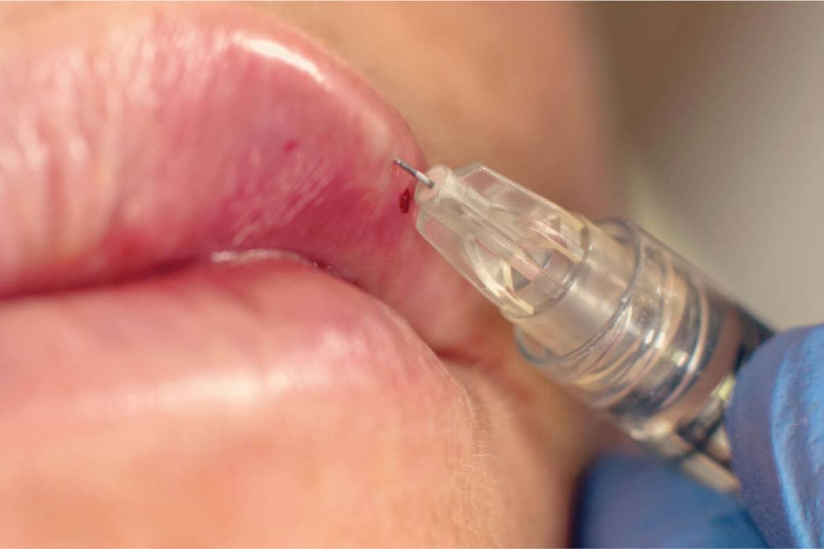 Fake doctor faces 30 years in prison for injecting silicone into clients