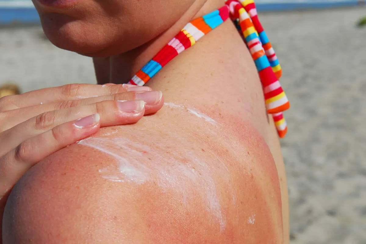 Health authorities warn of unusually high UV Radiation risk in the Canary Islands