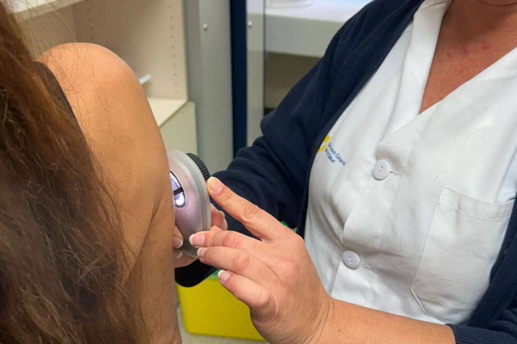 The Health Service introduces 1,400 devices for early skin cancer detection 