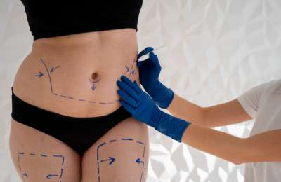 5 Benefits of Getting Liposculpture on the Gold Coast