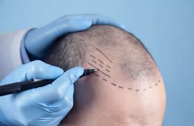 Life after a Hair Transplant: How to maintain your results and keep your confidence for years to come