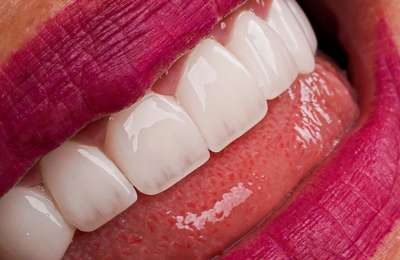 Hollywood Smile Makeover: What it is and how it can transform your confidence