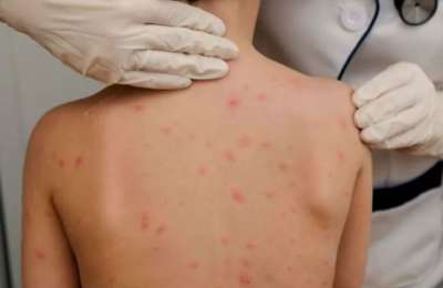 Measles are endemic in the Canary Islands after drop in vaccination levels 