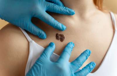 Skin cancer cases surge in the Canary Islands 