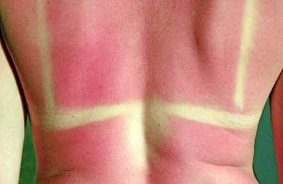 Dermatologist warns about the negative effects of sun exposure in the Canary Islands